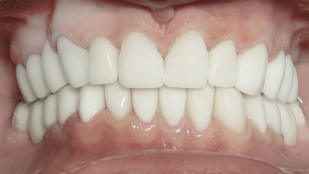 Z Systems Ceramic Dental Implants