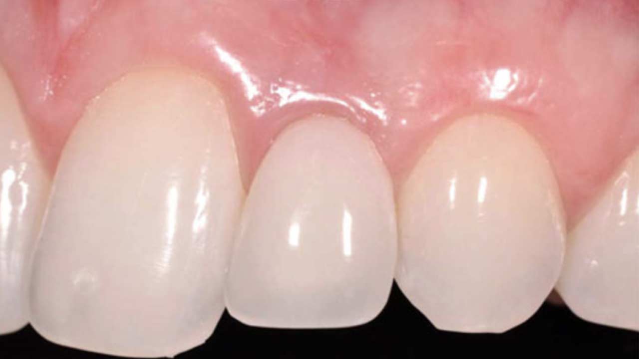 Ceramic Dental Implant Before and After