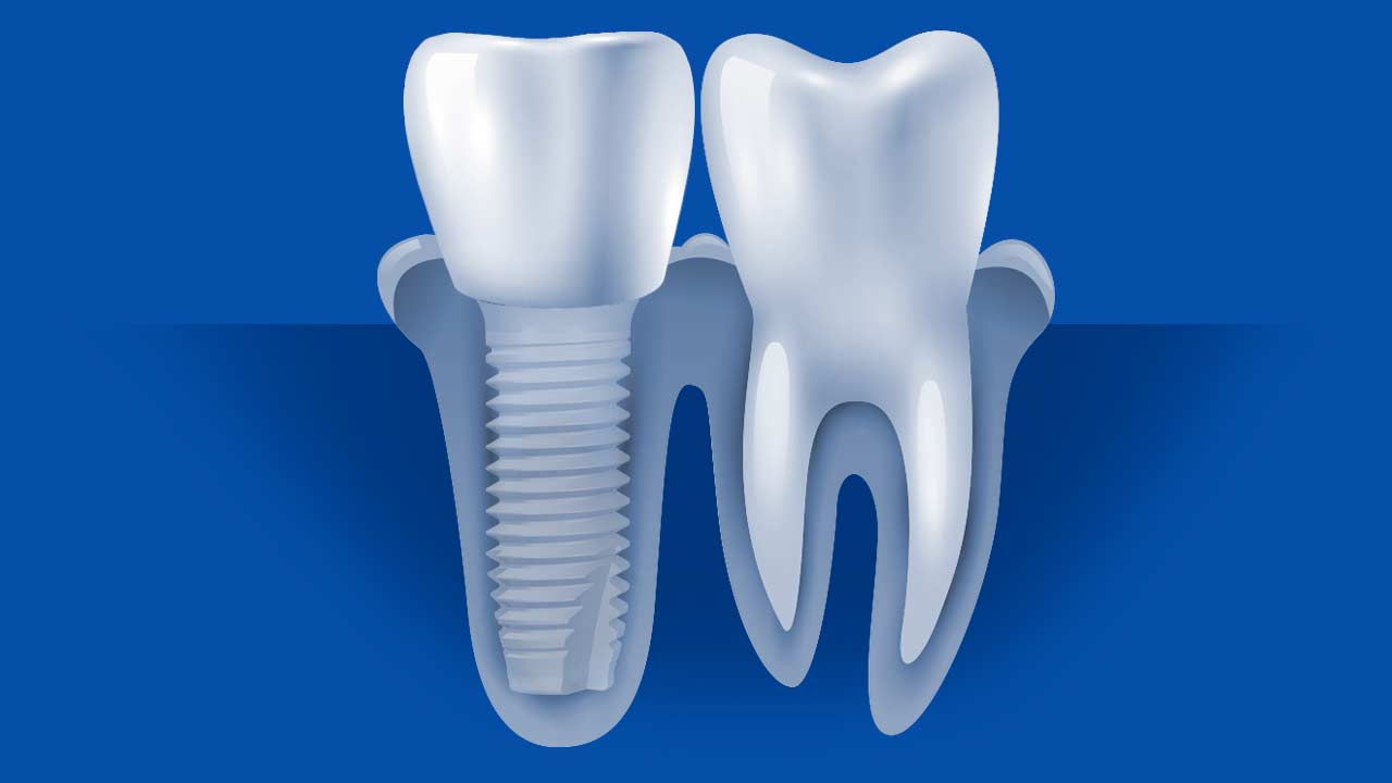 Ceramic Dental Implant Crown Diagram