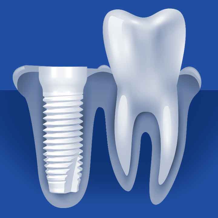 Ceramic Dental Implant Process