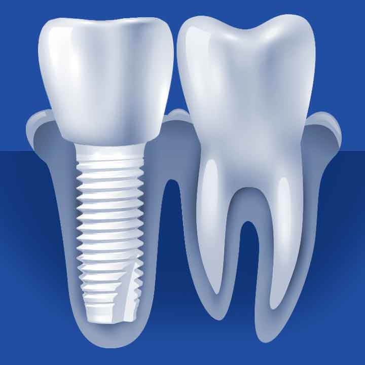 Ceramic Dental Implant Process