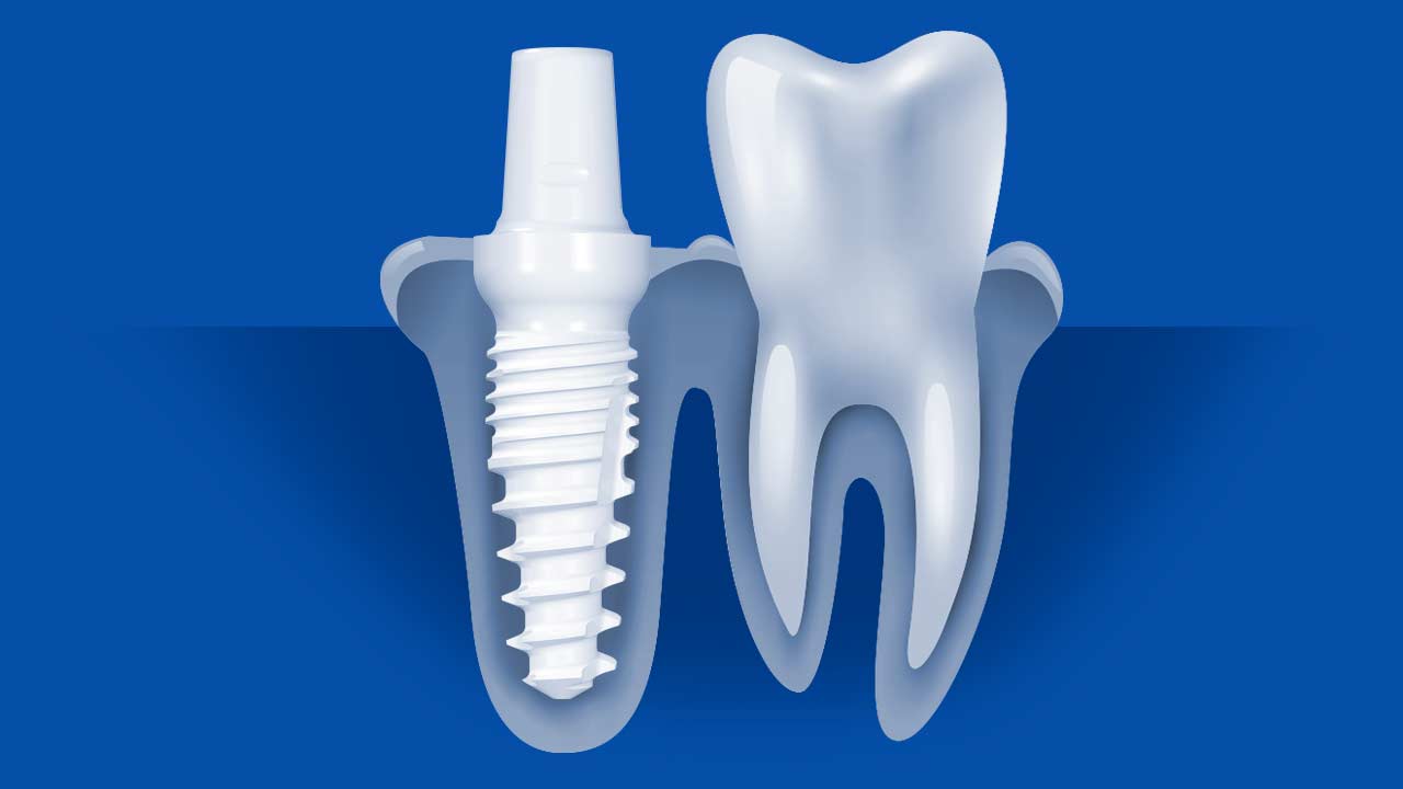 Ceramic Dental Implants For Your Dental Practice