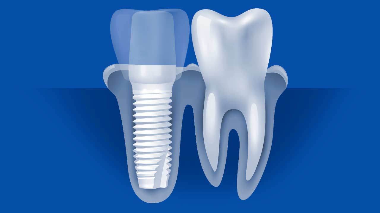 About Ceramic Dental Implants